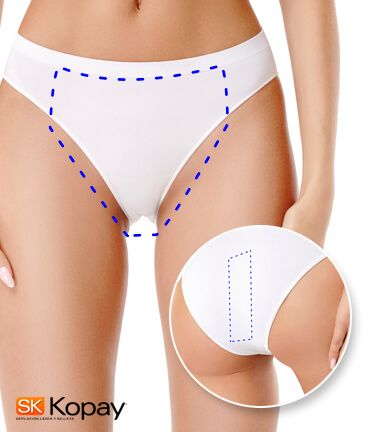 Tecnología YAG Candela facilita depilacion bikini brasileño en Kopay de Gele Giner Tecnología YAG Candela facilita depilacion bikini brasileño en Kopay de Gele Giner